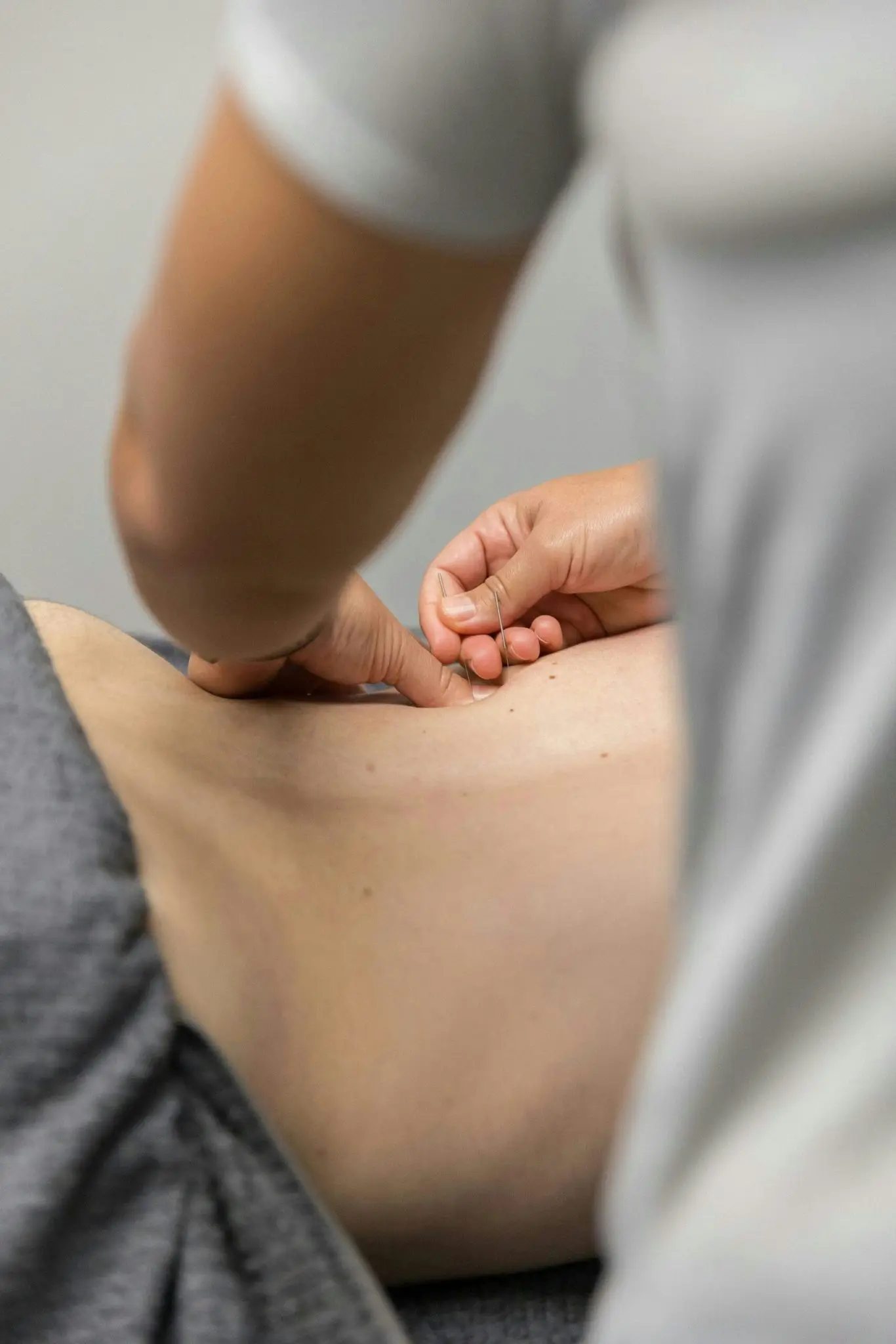 Dry Needling 1 era physiotherapy 007 scaled